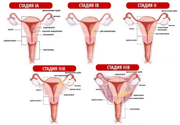 Опухоль яичника у женщин в менопаузе симптомы
